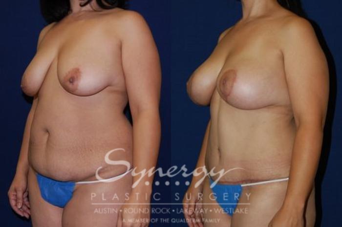 Before & After  Case 57 View #3 View in Austin, TX