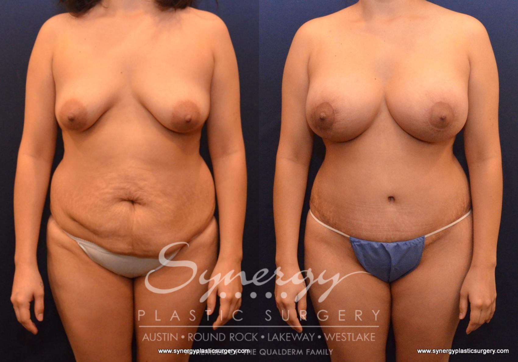 Before & After Mommy Makeover Case 608 View #1 View in Austin, TX