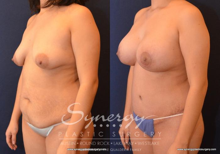 Before & After Mommy Makeover Case 608 View #2 View in Austin, TX