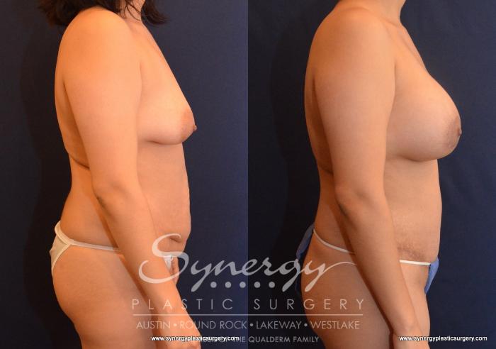 Before & After Mommy Makeover Case 608 View #3 View in Austin, TX