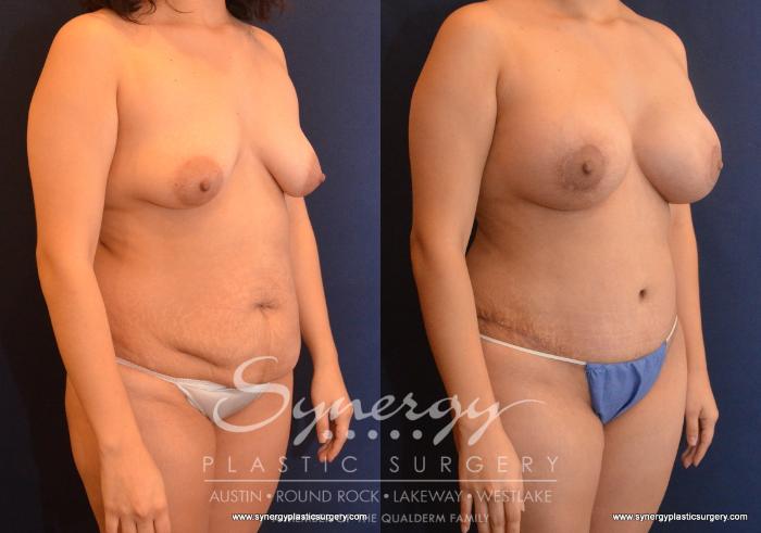 Before & After Mommy Makeover Case 608 View #4 View in Austin, TX