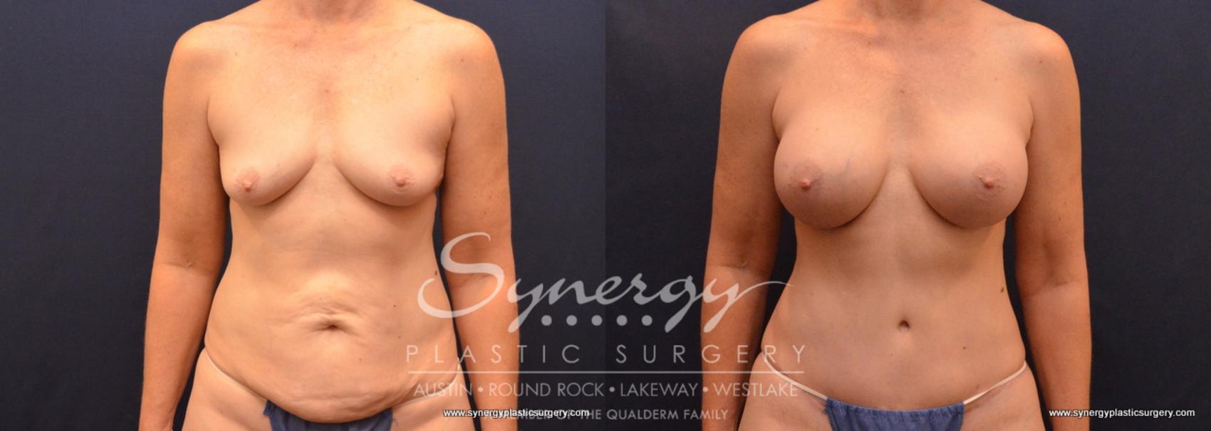 Before & After Mommy Makeover Case 660 View #1 View in Austin, TX