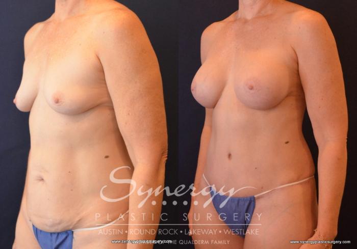 Before & After Mommy Makeover Case 660 View #2 View in Austin, TX