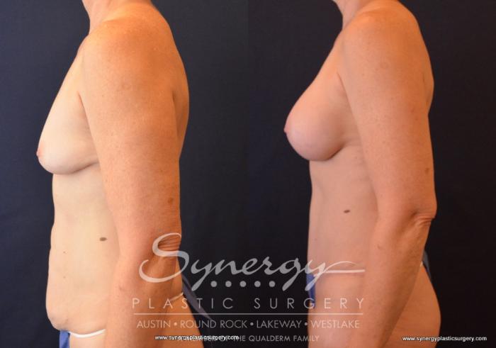 Before & After Mommy Makeover Case 660 View #3 View in Austin, TX