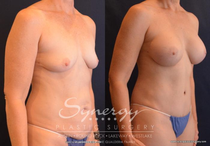 Before & After Mommy Makeover Case 660 View #4 View in Austin, TX