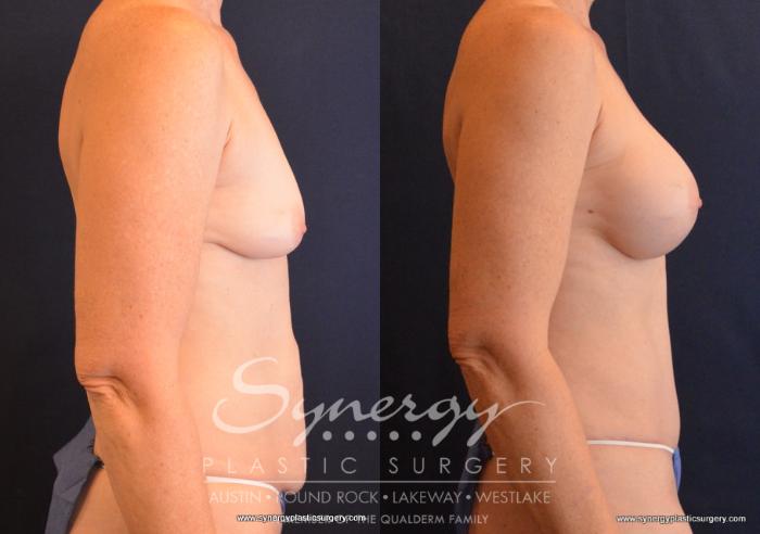 Before & After Mommy Makeover Case 660 View #5 View in Austin, TX