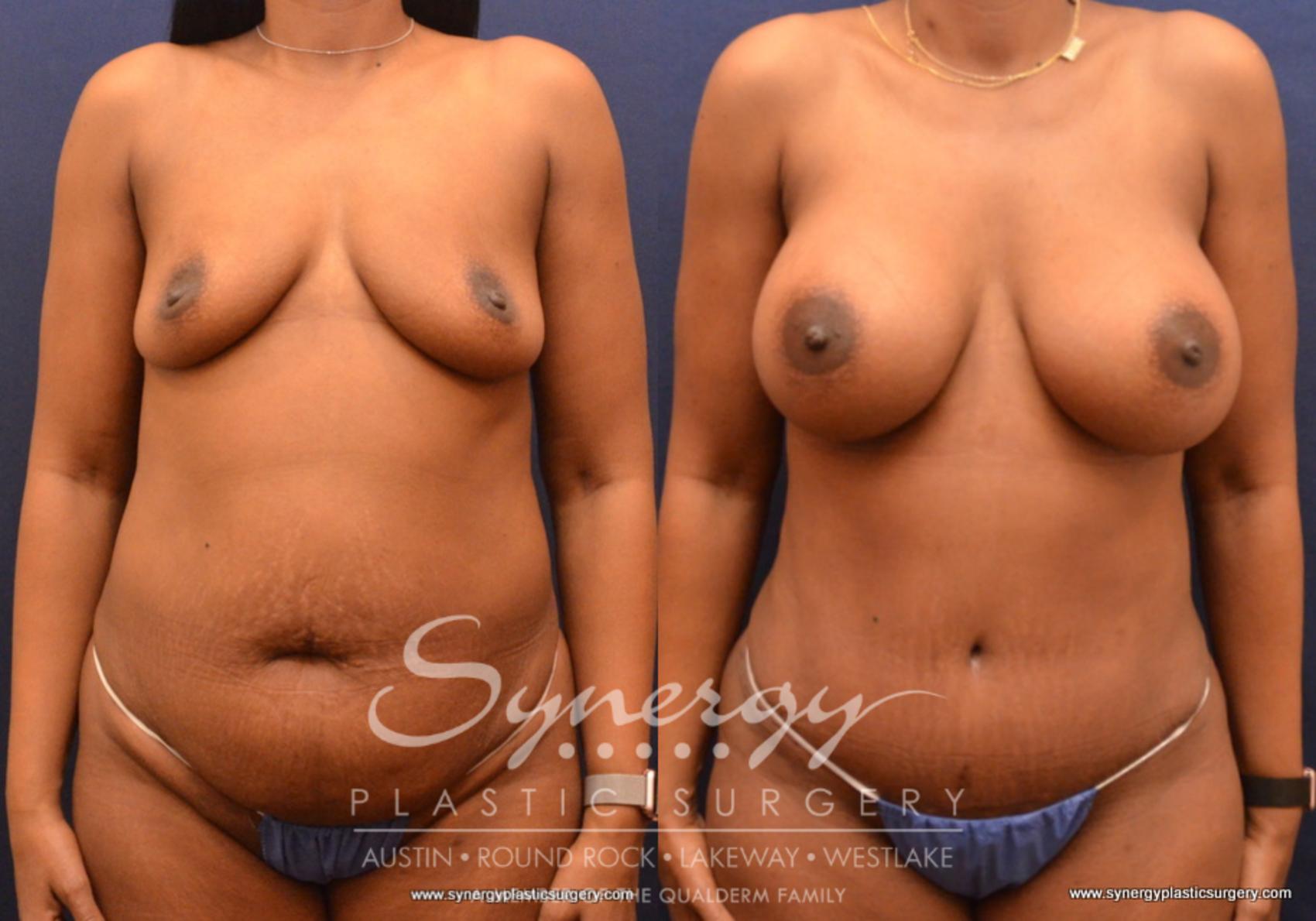 Before & After Mommy Makeover Case 667 View #1 View in Austin, TX