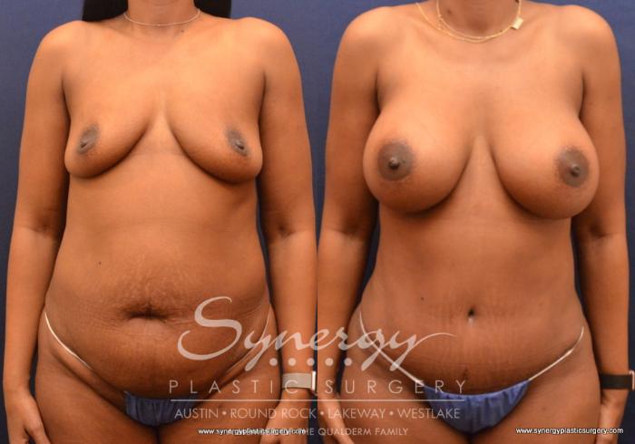 Before & After Mommy Makeover Case 667 View #1 View in Austin, TX