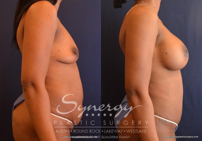 Before & After Mommy Makeover Case 667 View #4 View in Austin, TX