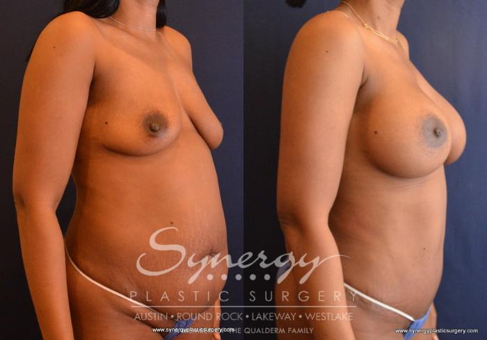 Before & After Mommy Makeover Case 667 View #5 View in Austin, TX