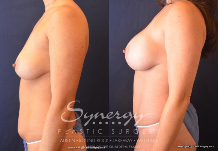 Before & After Mommy Makeover Case 683 View #2 View in Austin, TX