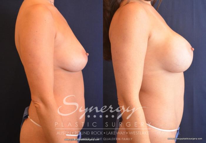 Before & After Mommy Makeover Case 683 View #3 View in Austin, TX