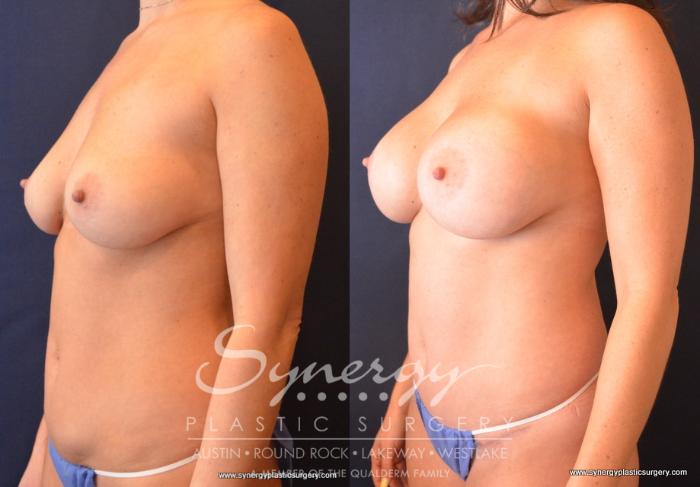 Before & After Mommy Makeover Case 683 View #4 View in Austin, TX