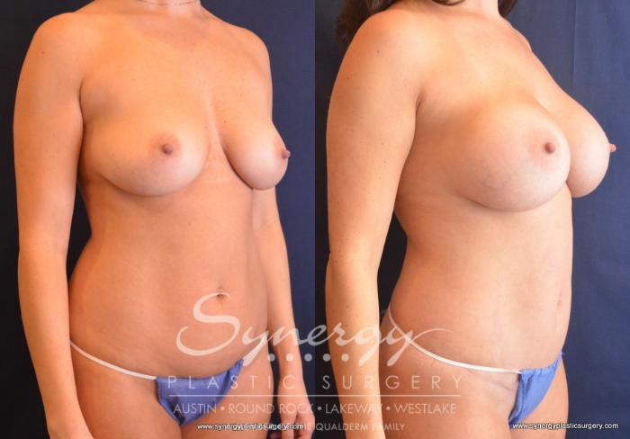 Before & After Mommy Makeover Case 683 View #5 View in Austin, TX