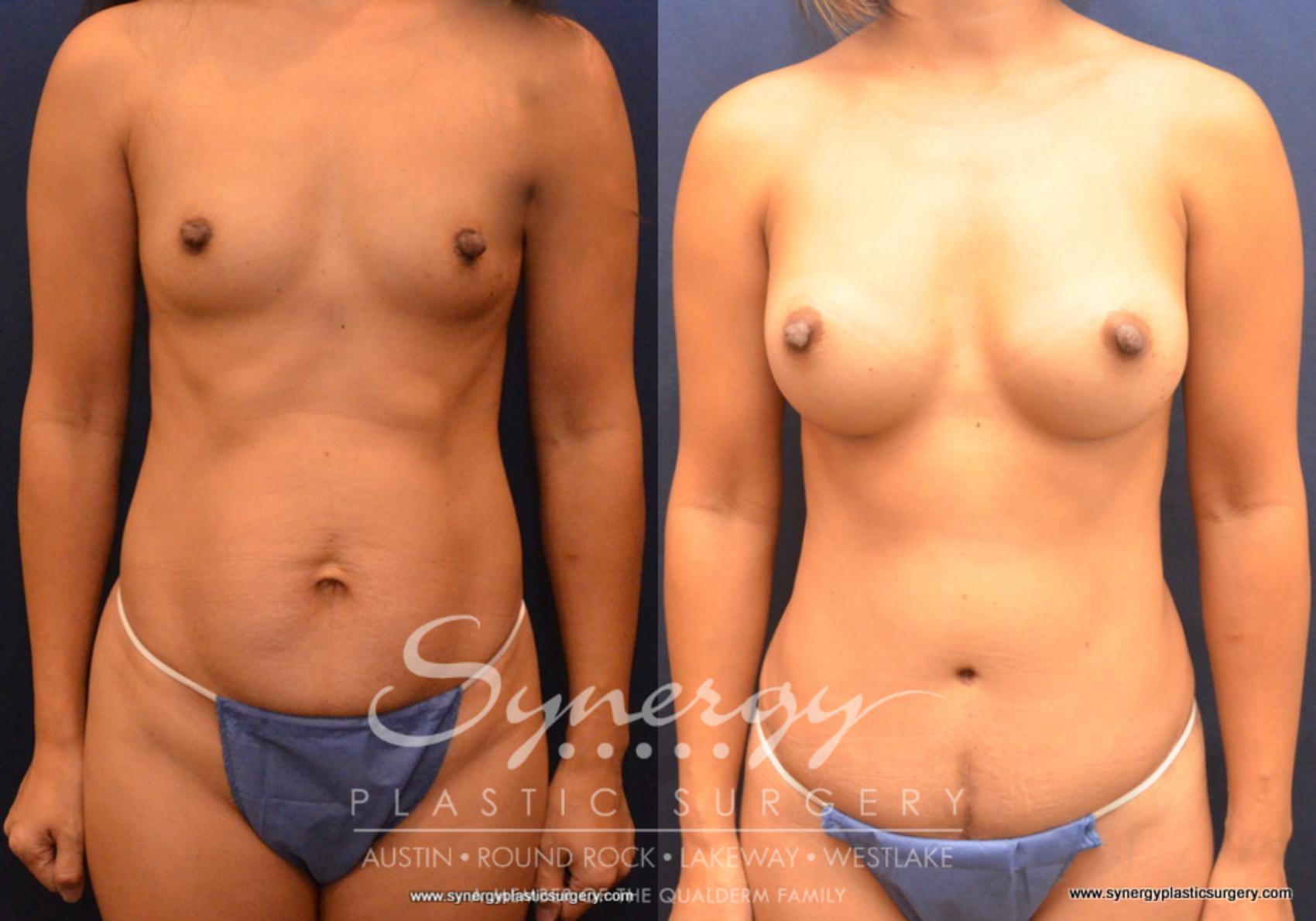 Before & After Mommy Makeover Case 692 View #1 View in Austin, TX