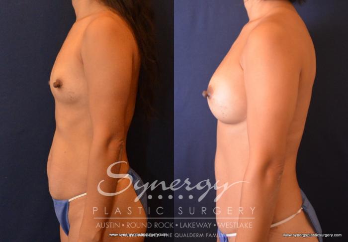 Before & After Mommy Makeover Case 692 View #2 View in Austin, TX