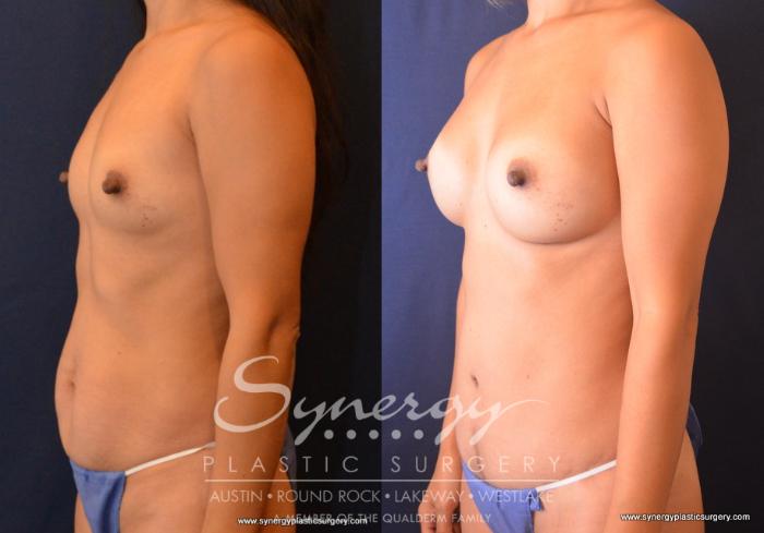 Before & After Mommy Makeover Case 692 View #3 View in Austin, TX