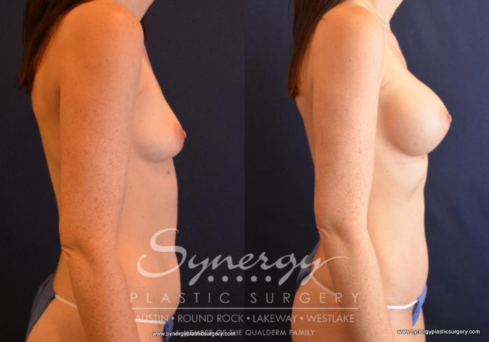 Before & After Mommy Makeover Case 694 View #4 View in Austin, TX