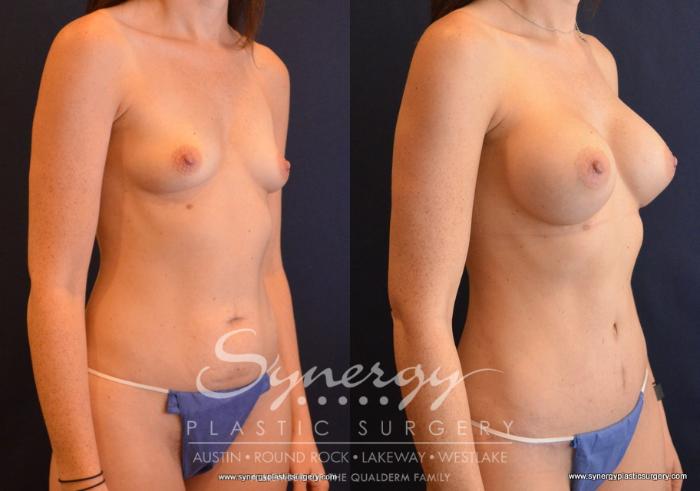 Before & After Mommy Makeover Case 694 View #5 View in Austin, TX