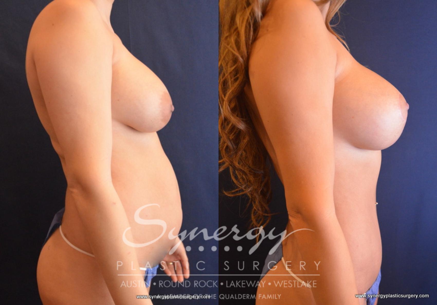 Before & After Mommy Makeover Case 699 View #3 View in Austin, TX