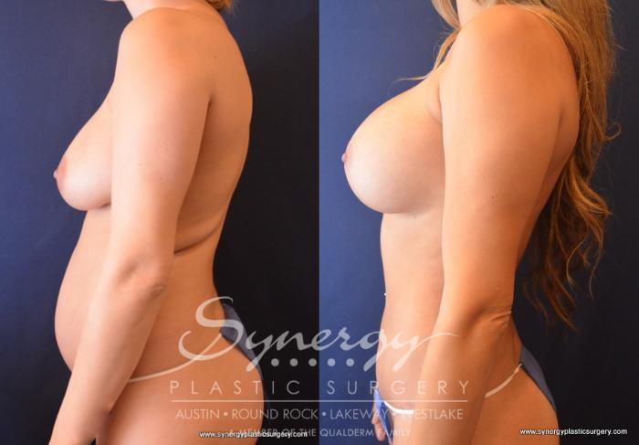 Before & After  Case 699 View #4 View in Austin, TX