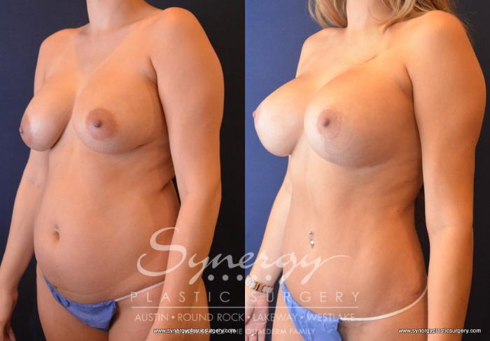 Before & After  Case 699 View #5 View in Austin, TX