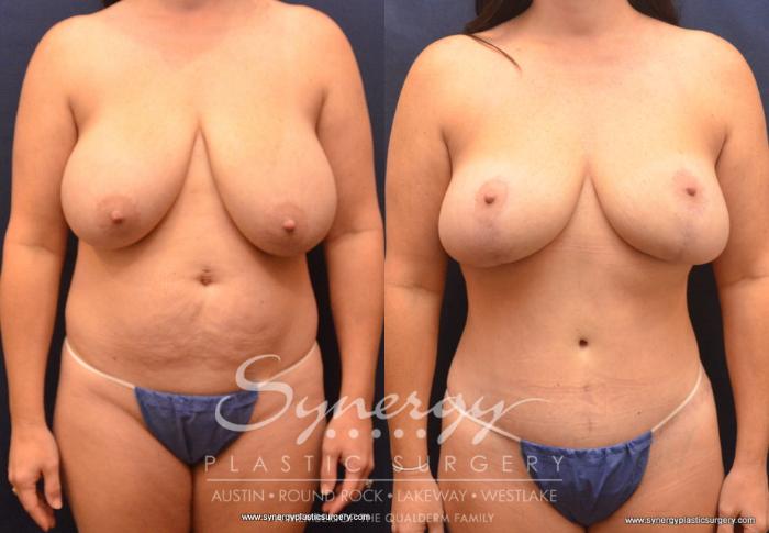 Before & After Mommy Makeover Case 703 View #1 View in Austin, TX