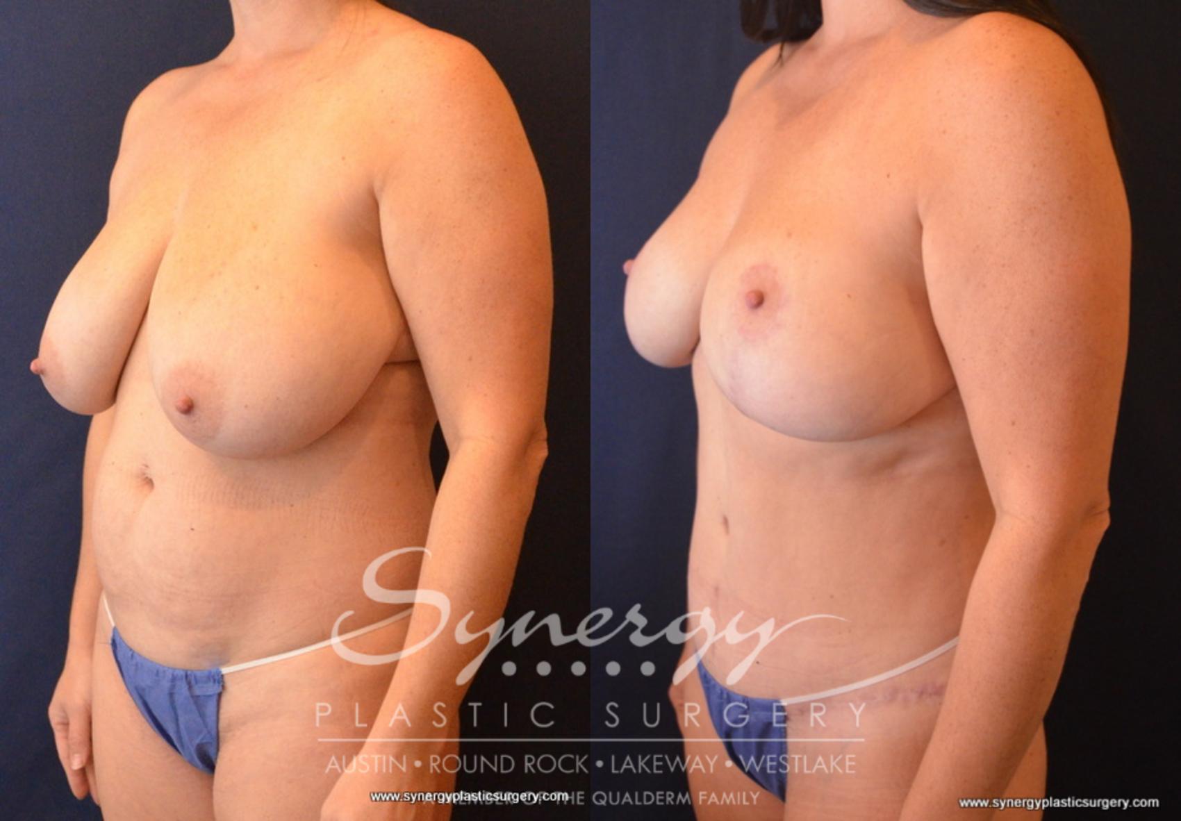 Before & After Mommy Makeover Case 703 View #2 View in Austin, TX