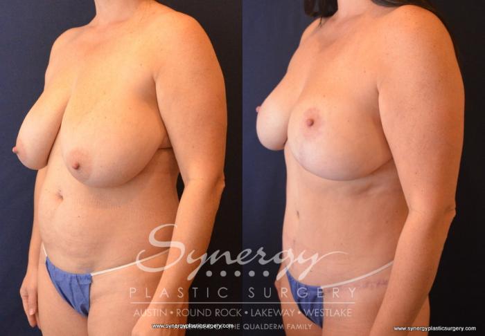 Before & After Mommy Makeover Case 703 View #2 View in Austin, TX