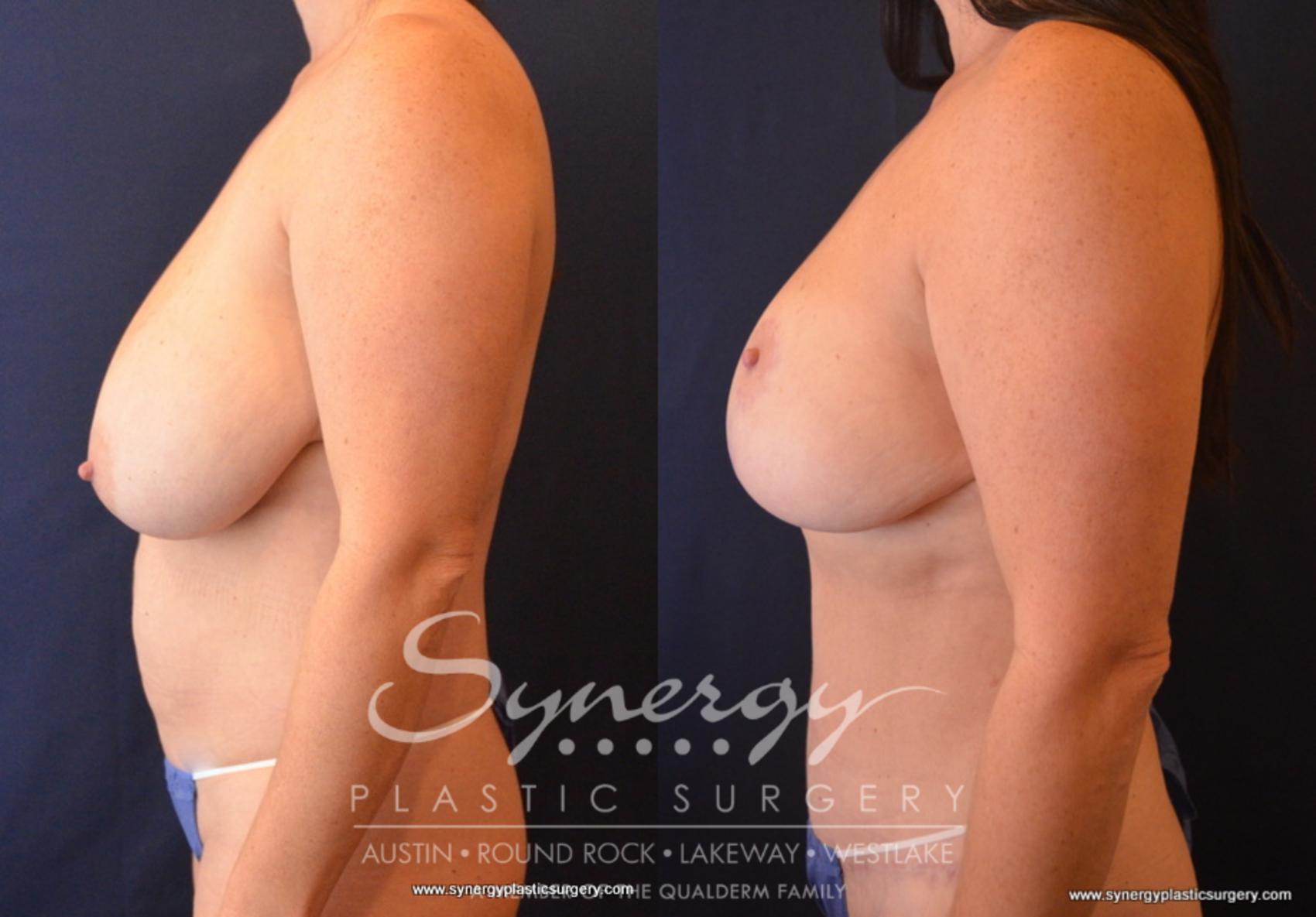 Before & After Mommy Makeover Case 703 View #3 View in Austin, TX