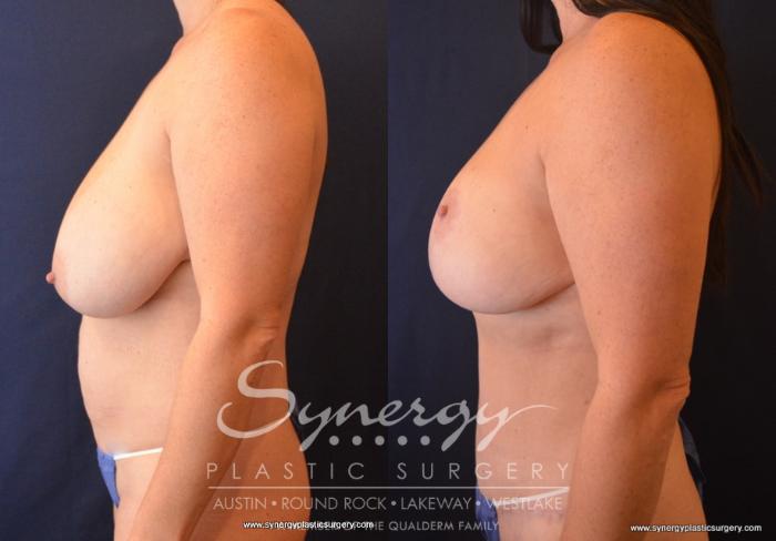 Before & After Mommy Makeover Case 703 View #3 View in Austin, TX