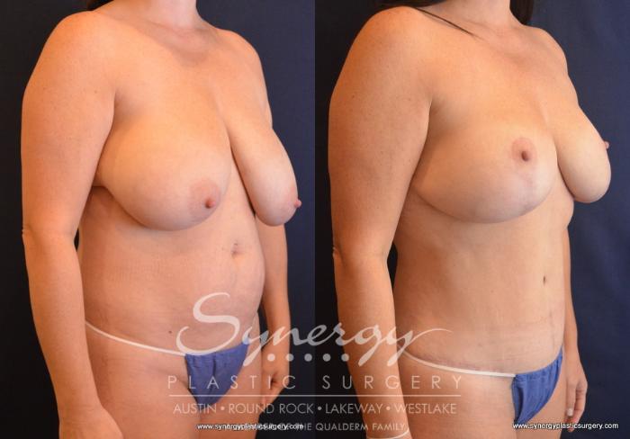 Before & After Mommy Makeover Case 703 View #4 View in Austin, TX