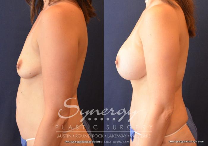 Before & After Mommy Makeover Case 722 View #3 View in Austin, TX