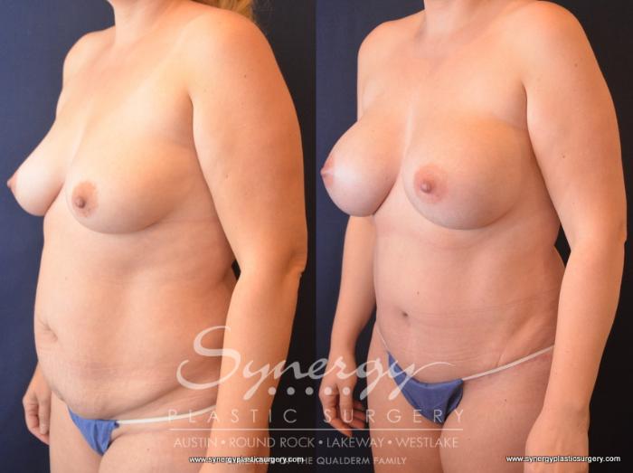 Before & After Mommy Makeover Case 729 View #2 View in Austin, TX