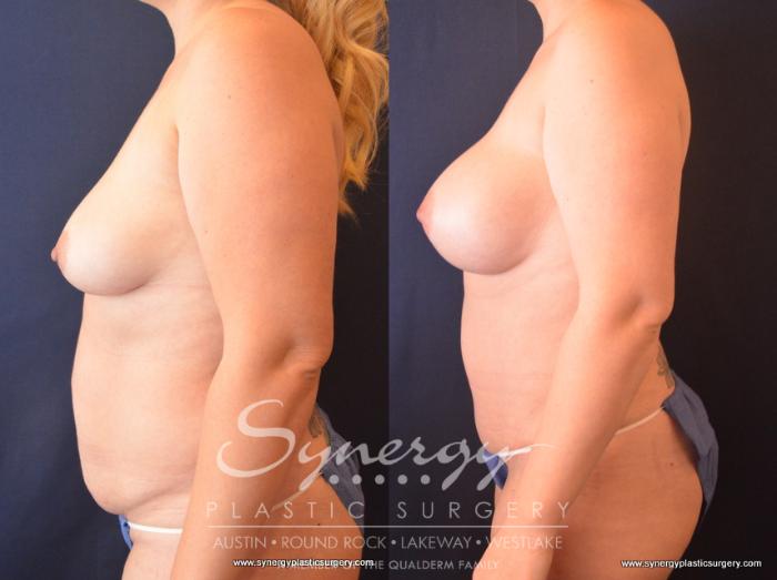 Before & After Mommy Makeover Case 729 View #3 View in Austin, TX