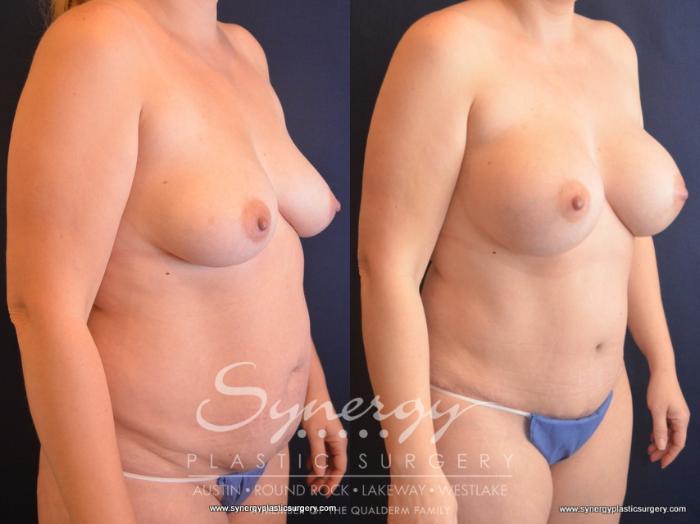 Before & After Mommy Makeover Case 729 View #4 View in Austin, TX