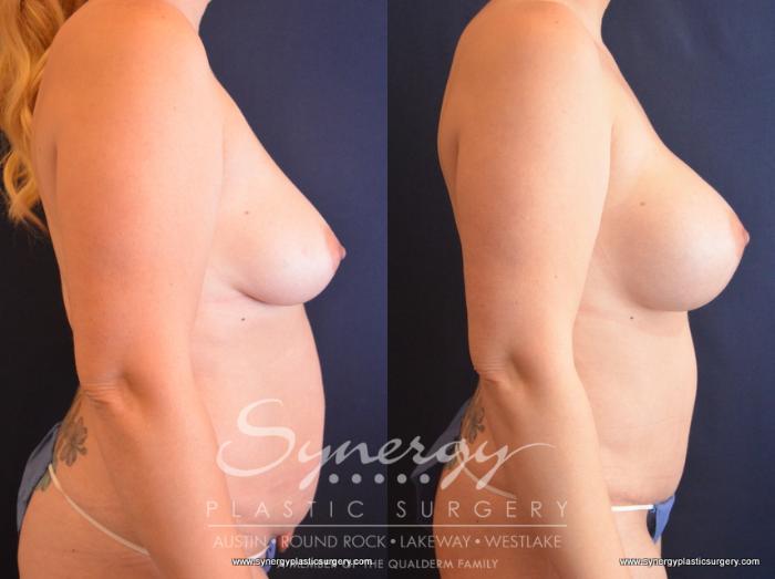 Before & After Mommy Makeover Case 729 View #5 View in Austin, TX
