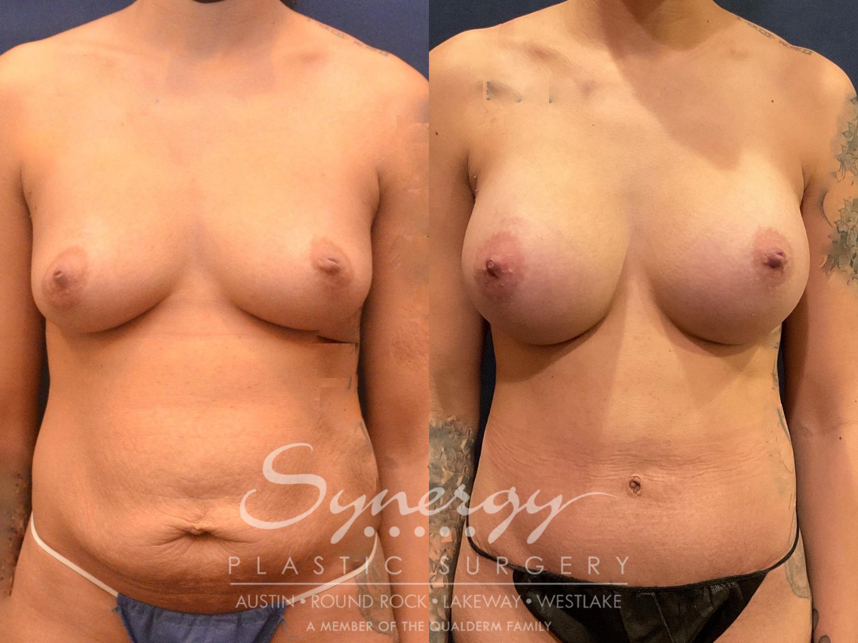 mommy make-over, synergy plastic surgery 