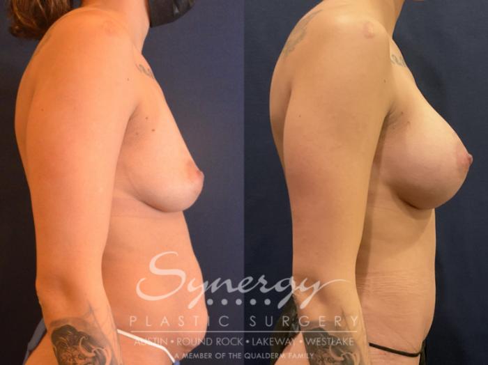 mommy make-over, synergy plastic surgery 