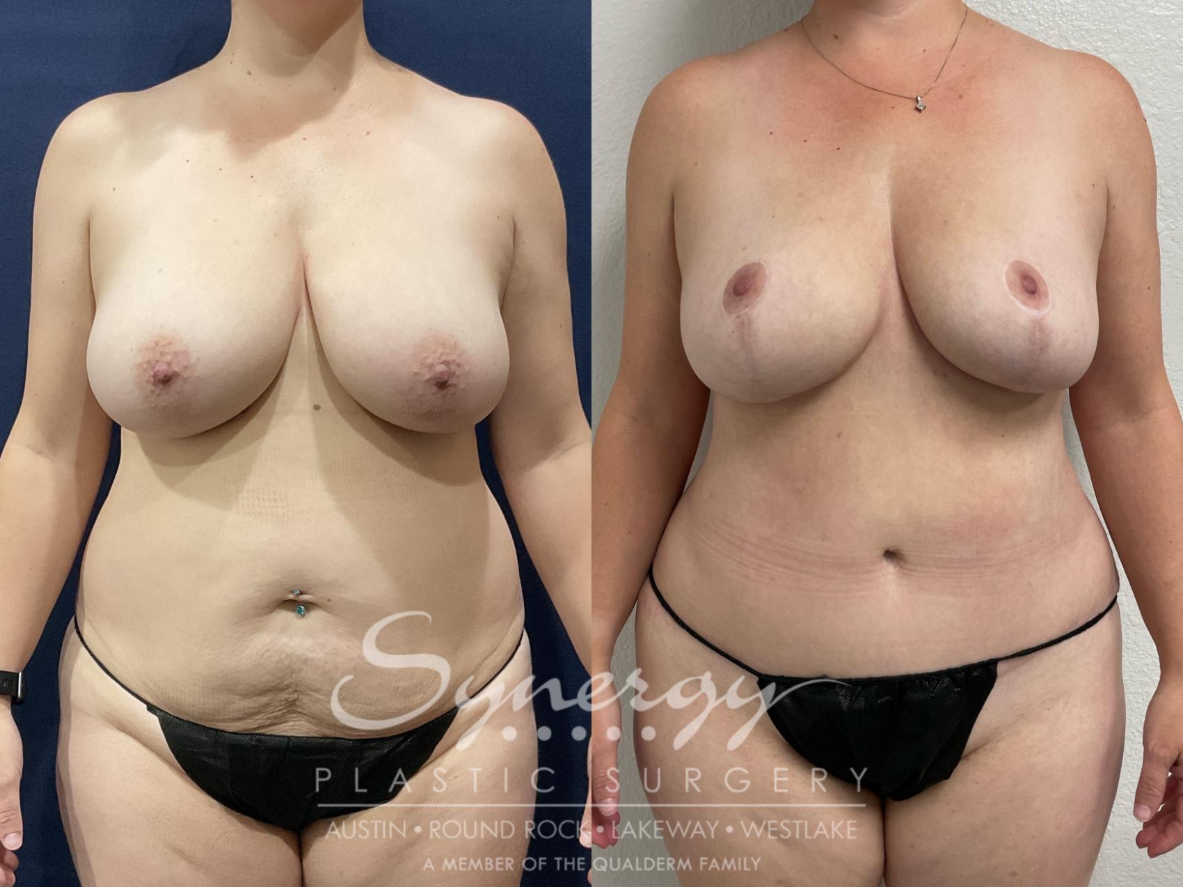 Before & After Mommy Makeover Case 882 Front View in Austin, TX