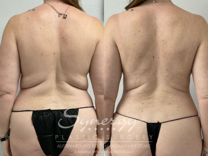 Before & After Mommy Makeover Case 949 Back View in Austin, TX