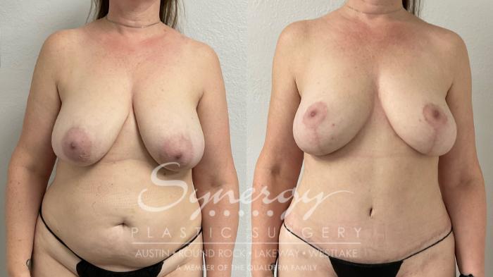 Before & After Mommy Makeover Case 949 Front View in Austin, TX