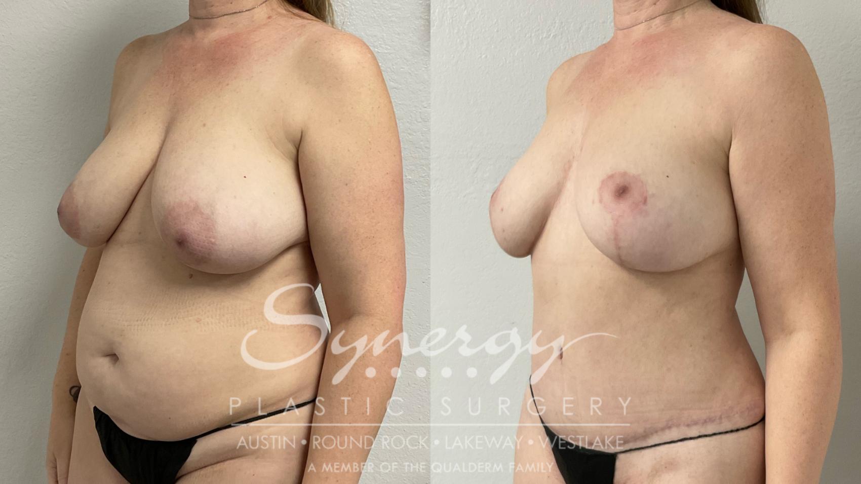 Before & After Mommy Makeover Case 949 Left Oblique View in Austin, TX