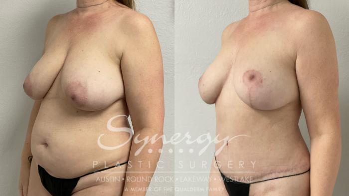 Before & After Mommy Makeover Case 949 Left Oblique View in Austin, TX