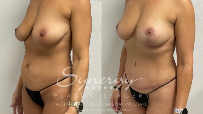 Breast Lift Before & After Photos | 48-Year-Old Patient | Synergy Plastic Surgery Austin