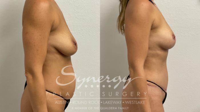 Breast Lift Before & After Photos | 48-Year-Old Patient | Synergy Plastic Surgery Austin