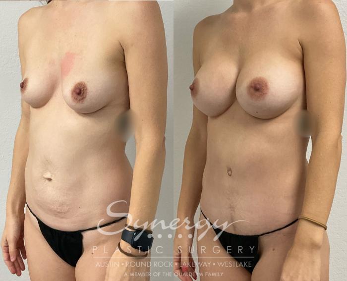 Before & After Mommy Makeover Case 957 Left Oblique View in Austin, TX