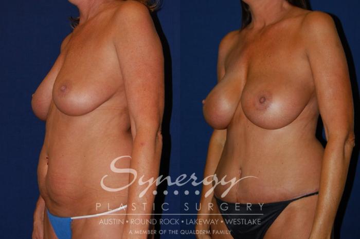 Before & After Mommy Makeover Case 96 View #1 View in Austin, TX