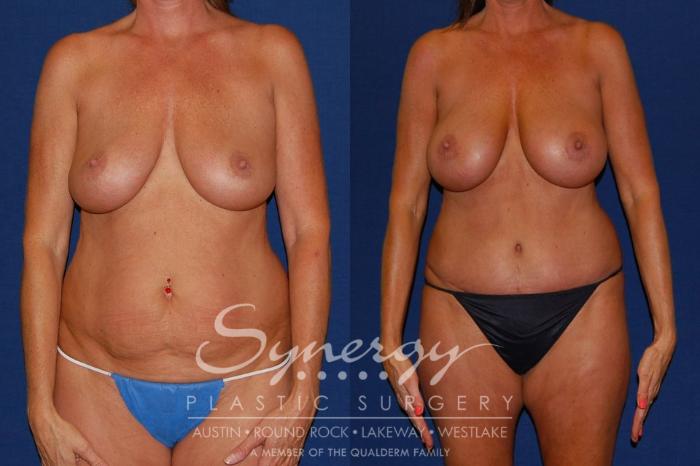 Before & After Mommy Makeover Case 96 View #3 View in Austin, TX