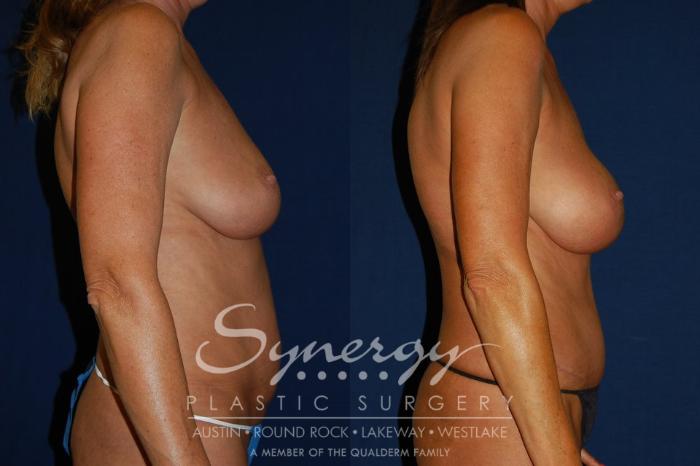 Before & After Mommy Makeover Case 96 View #4 View in Austin, TX